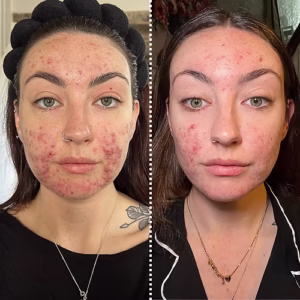 Before and After LED Mask Therapy - Wrinkle Reduction on Woman's Face