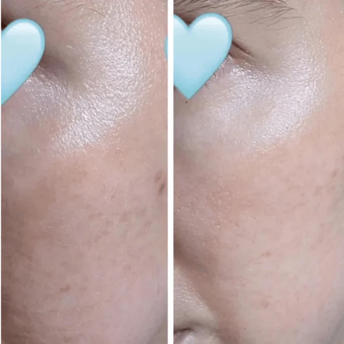 Before and After LED Mask Therapy - Wrinkle Reduction on Woman's Face