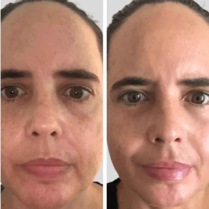 Before and After LED Mask Therapy - Wrinkle Reduction on Woman's Face
