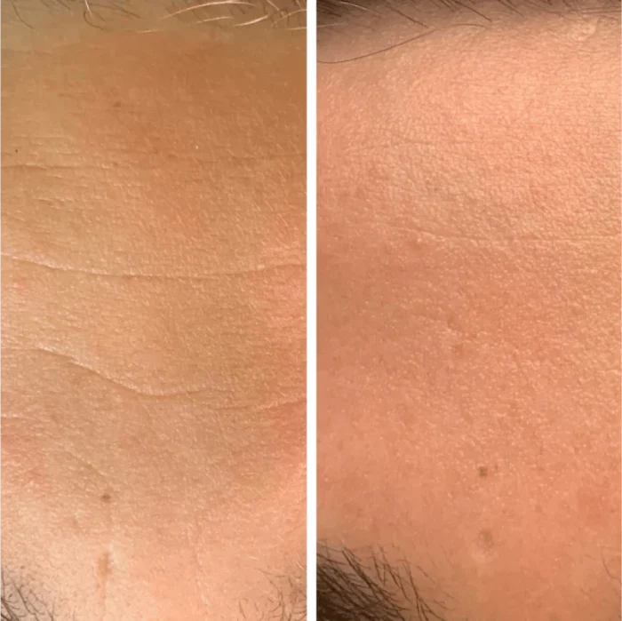 Before and After LED Mask Therapy - Wrinkle Reduction on Woman's Face