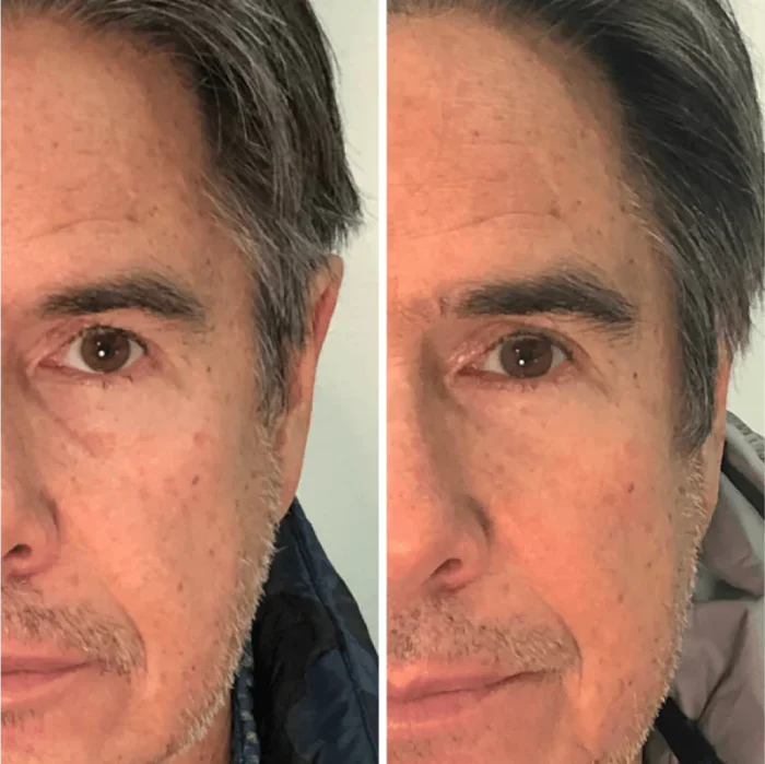 Before and After LED Mask Therapy - Wrinkle Reduction on Woman's Face