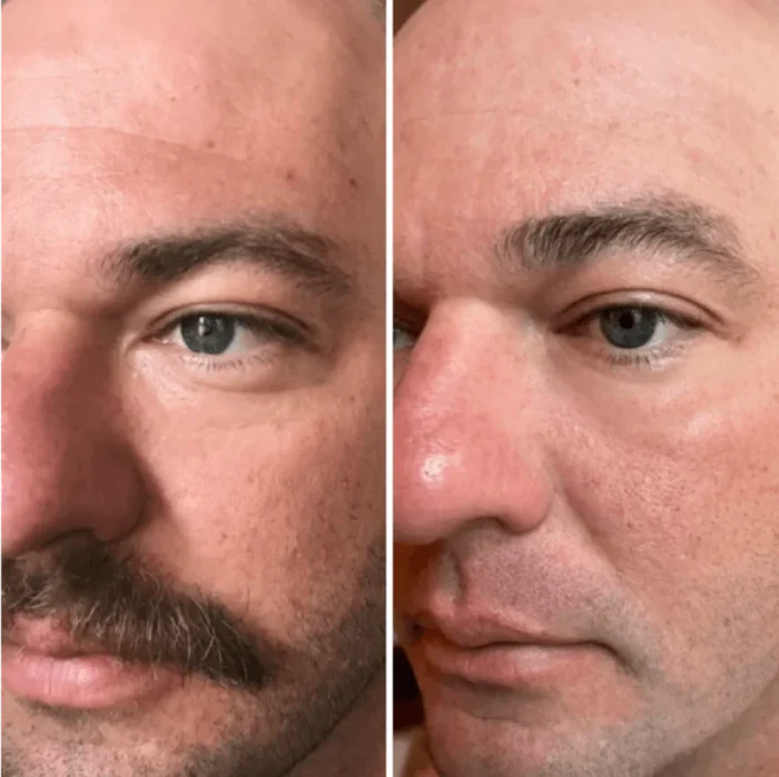 Before and After LED Mask Therapy - Wrinkle Reduction on Woman's Face