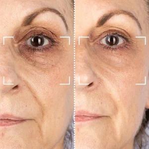 Before and After LED Mask Therapy - Wrinkle Reduction on Woman's Face