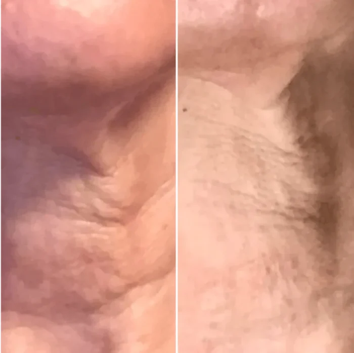 Before and After LED Mask Therapy - Wrinkle Reduction on Woman's Face