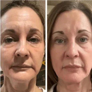 Before and After LED Mask Therapy - Wrinkle Reduction on Woman's Face