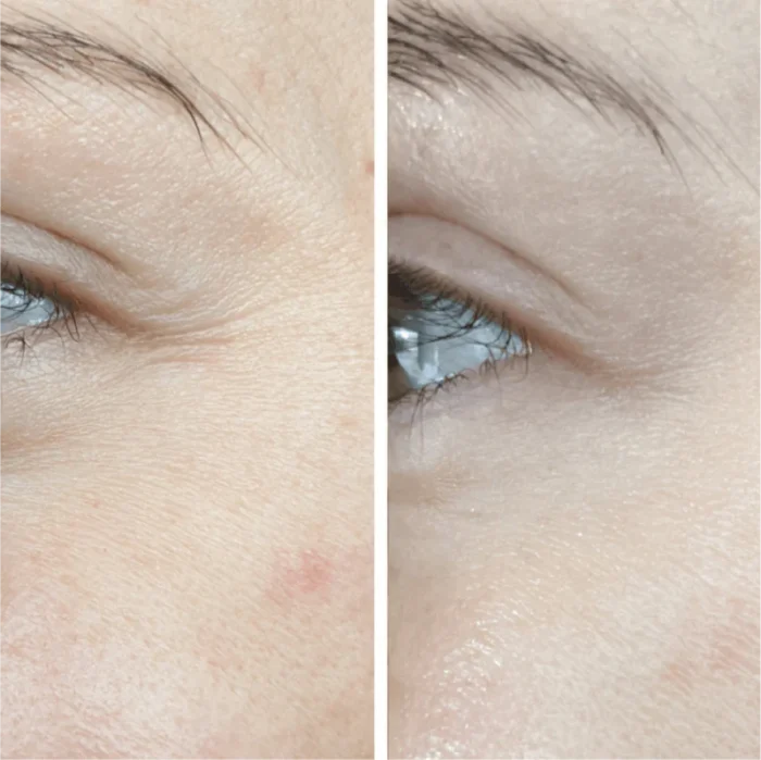 Before and After LED Mask Therapy - Wrinkle Reduction on Woman's Face