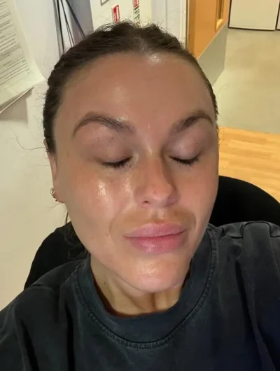 After LED Skincare Treatment Woman's face after LED light skincare treatment with clearer and smoother skin