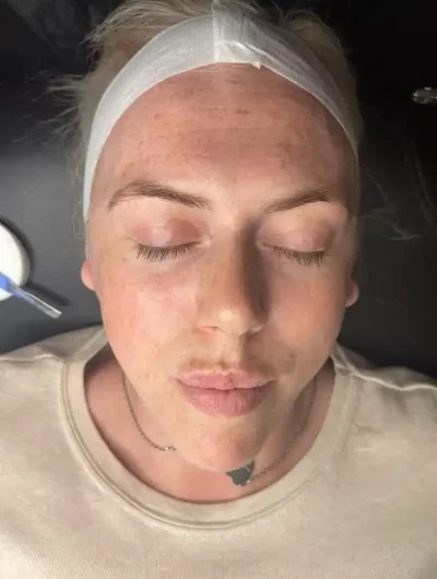 Before LED Skincare Treatment Close-up of woman's face before LED light skincare treatment showing skin imperfections