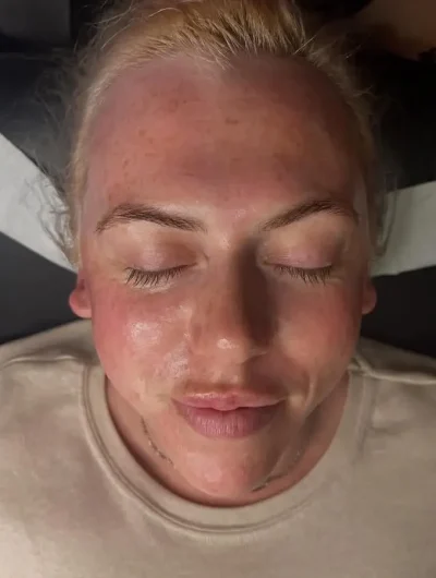 After LED Skincare Treatment Woman's face after LED light skincare treatment with clearer and smoother skin