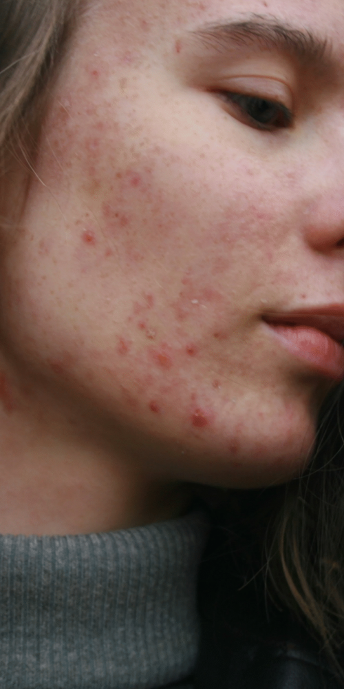 Before Treatment – Sensitive Skin and Inflammation Woman with sensitive skin and redness looking down – before skincare treatment
